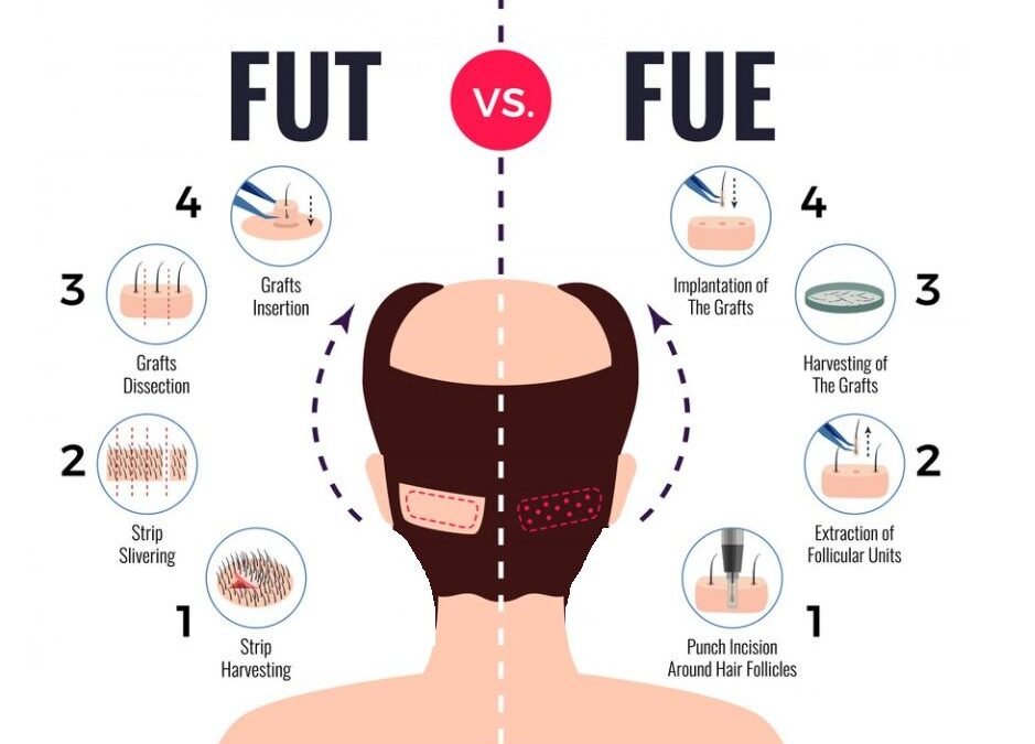 FUE vs FUT differences