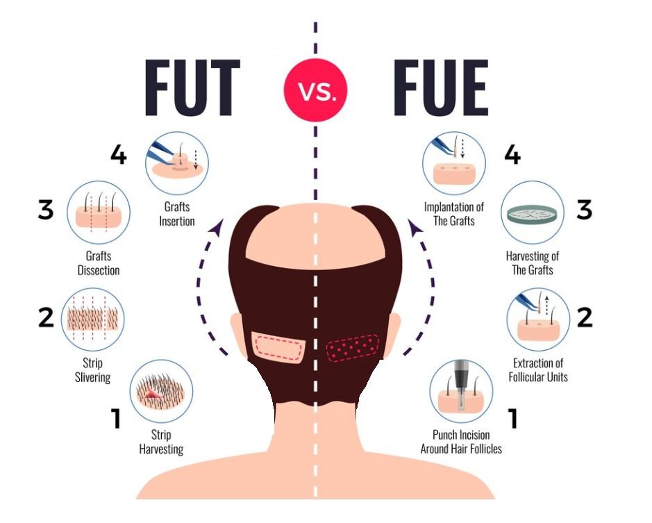 FUE vs FUT differences