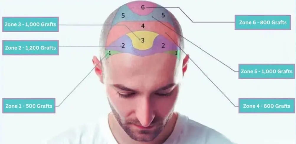 Preparation for hair transplant procedure