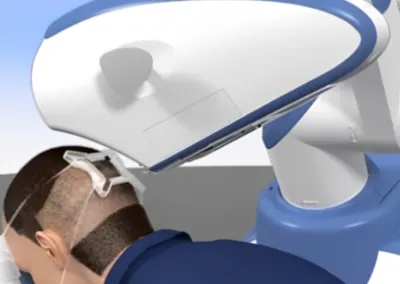 AI Hair Transplant