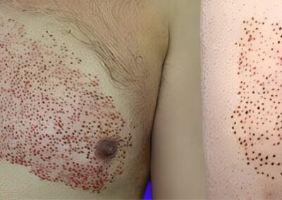 Body Hair Transplant