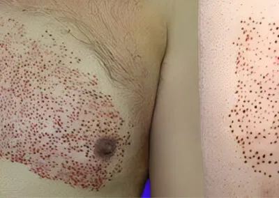 Body Hair Transplant