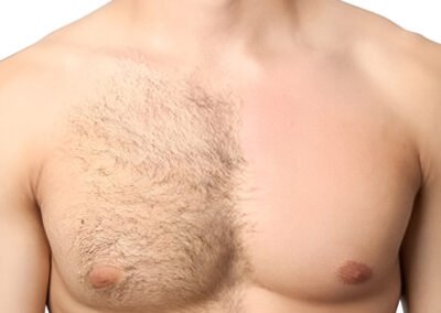 Body Hair Transplant therapy