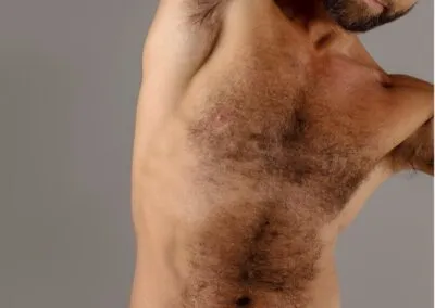 Body Hair Transplant Services for men