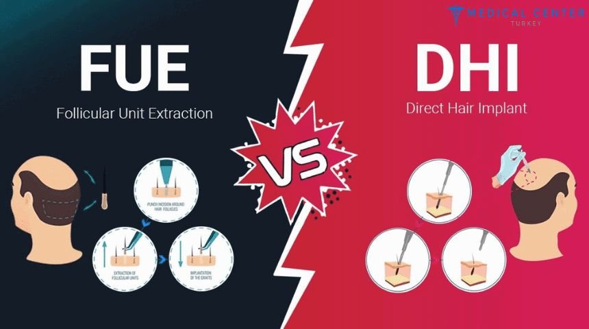 dhi vs fue hair transplant