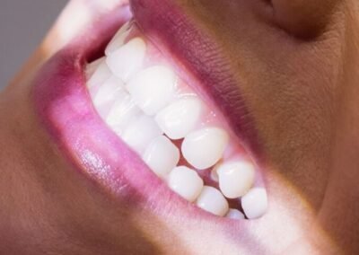 Dental Treatments Teeth Whitening via Cure & Travel