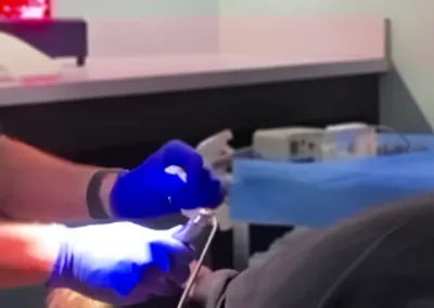 Executive Non-Shaving Hair Transplant