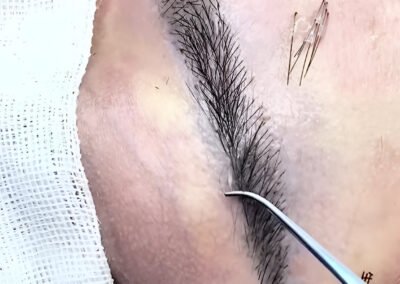 Eyebrow Transplantation Turkey