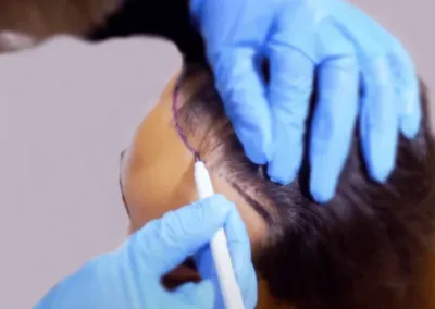 Before and after female hair transplant