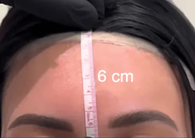 Forehead Hairline