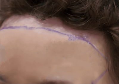 Forehead Hairline Lowering Turkey