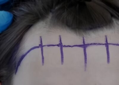 Forehead Hairline Lowering