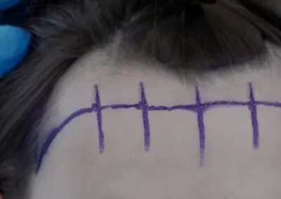 Forehead Hairline Lowering