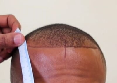 afro hair transplant service turkey