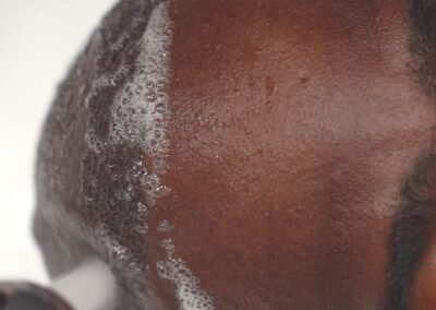 afro hair transplant