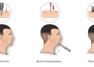 beard transplant procedure