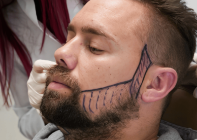 beard transplant service by professionals